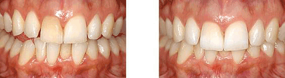 tooth whitening - before and after picture